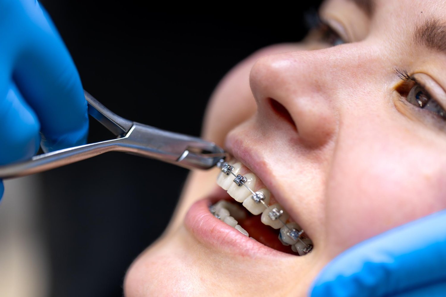 Dental Braces Treatment