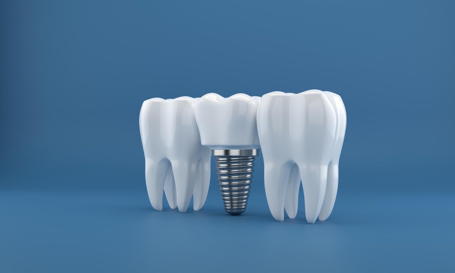 Dental Implants